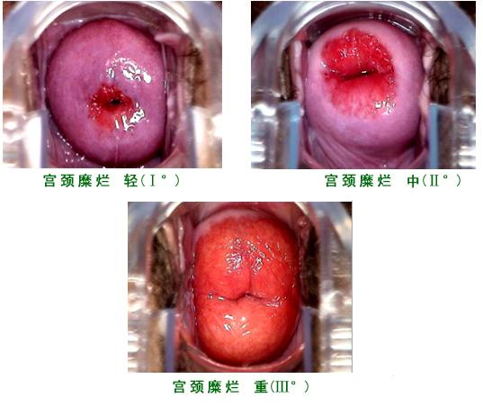 宮頸糜爛最新手術(shù)治療，重拾自信與健康的秘訣?